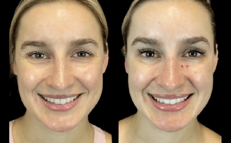 Best Doctors in dubai Reveal the Secret to Long-Lasting Botox Results