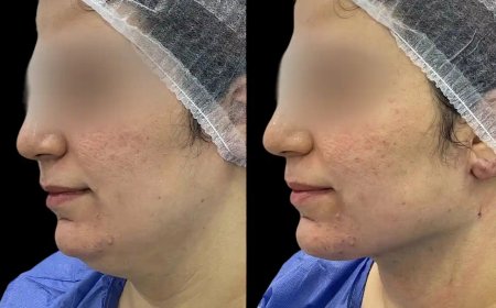 What Sets the Best Doctors in dubai for Chin Fillers Apart in Non-Invasive Procedures