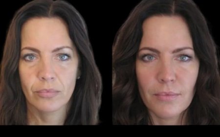 Best Doctors in dubai for Jawline Fillers: Achieving Subtle Enhancement