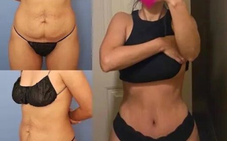 The Best Doctors in Dubai for Tummy Tuck: What Patients Say