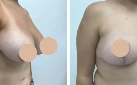 The Recovery Experience: Breast Lift in Dubai with the Best Doctors in Dubai