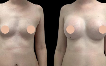 Elegance Perfected by the Best Breast Augmentation Surgeon in Dubai