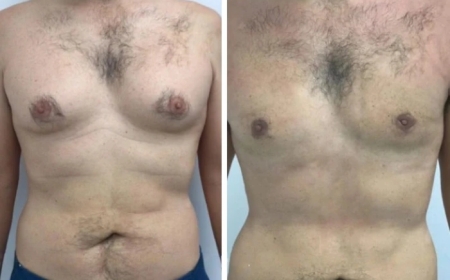The Importance of Choosing Experienced Doctors for Gynecomastia Surgery in Dubai