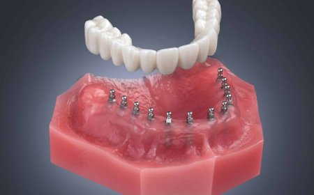 Top 7 Questions About Marietta Dental Implants Answered by a Local Expert