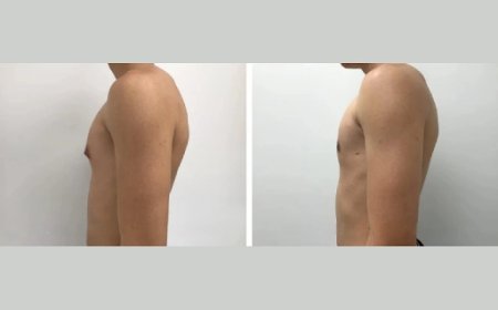 How to Find the Best Gynecomastia Surgeon in Dubai for Minimal Scarring Results