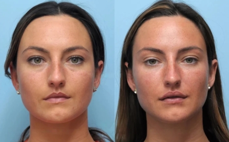 How the Best Plastic Surgeon in Dubai for Thread Lift Achieves Facial Perfection