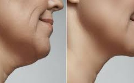 Non-Surgical Neck Tightening Treatments: What to Expect
