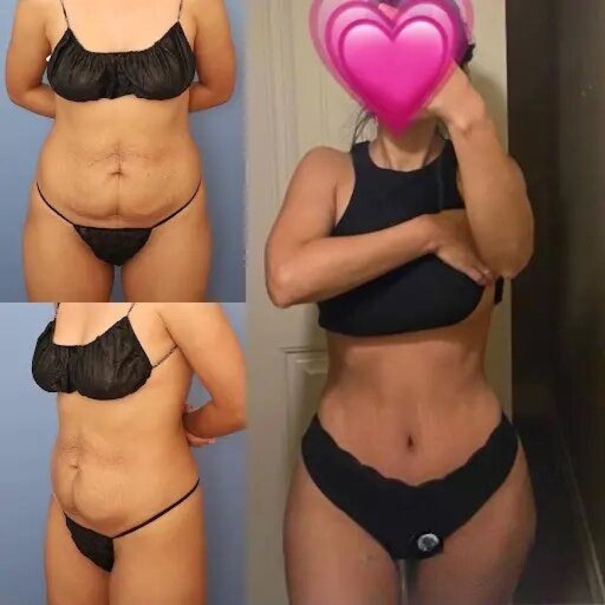 The Best Doctors in Dubai for Tummy Tuck: What Patients Say