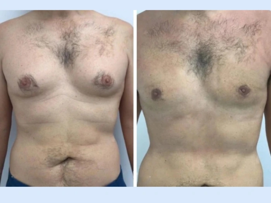 Preparing Mentally for Gynecomastia in Dubai Surgery