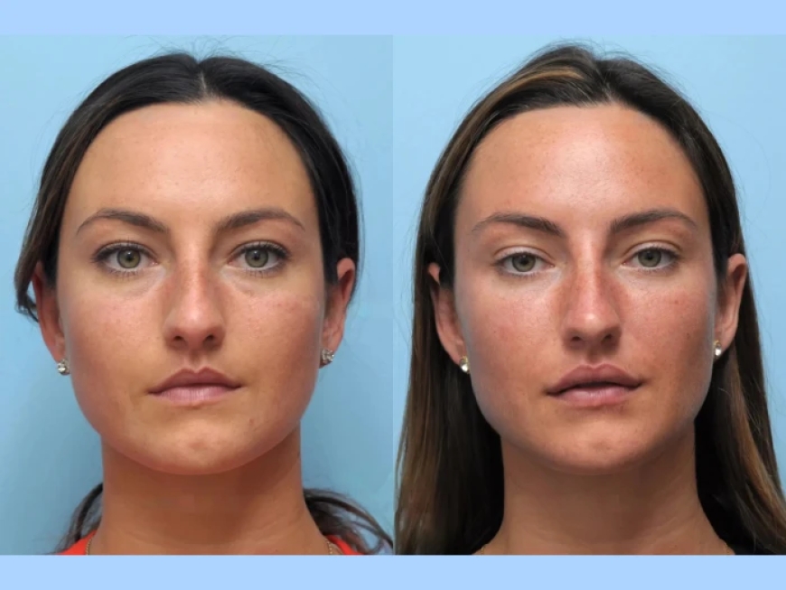 How the Best Plastic Surgeon in Dubai for Thread Lift Achieves Facial Perfection