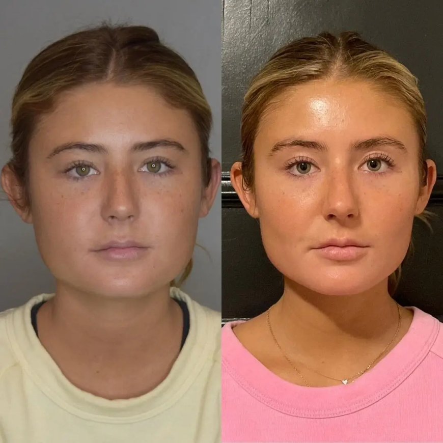 Your Smile Enhanced by the Best Buccal fat removal Surgeons in Dubai