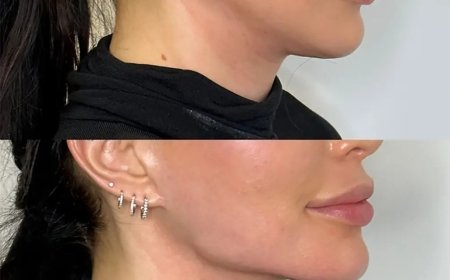 Best Doctors in Dubai for Jawline Filler Treatments