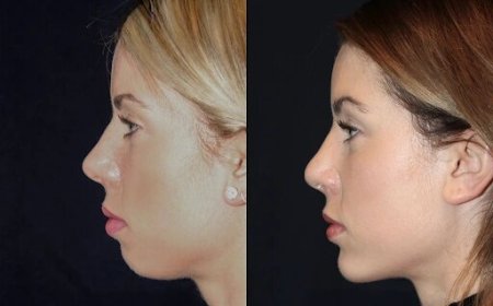 Chin Fillers in Dubai: The Importance of Medical Expertise