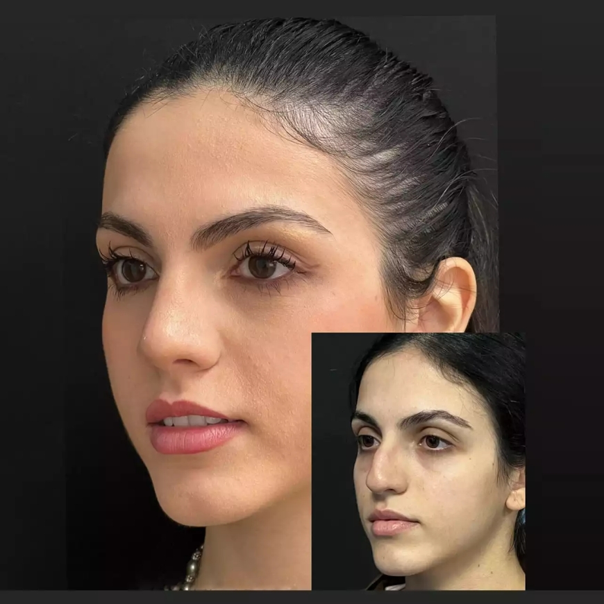 Best Doctors in Dubai for Rhinoplasty Share Their Top Techniques