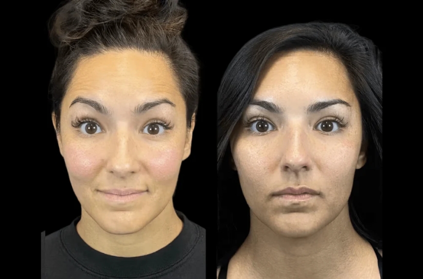 The Best Aesthetic Clinics in dubai for Long-Lasting Botox Results