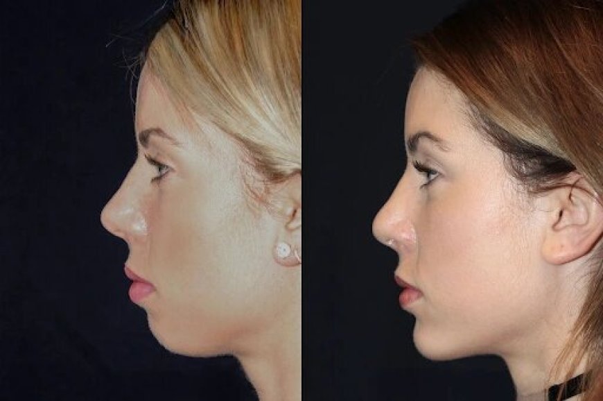 Chin Fillers in Dubai: The Importance of Medical Expertise